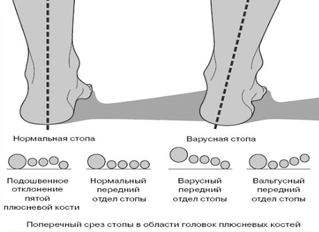 Варусные стопы мкб. Вальгусная и варусная деформация стопы. Плоско вальгусная деформация рентген. Вальгусная стопа и варусная стопа. Вальгус и Варус стопы у ребенка.